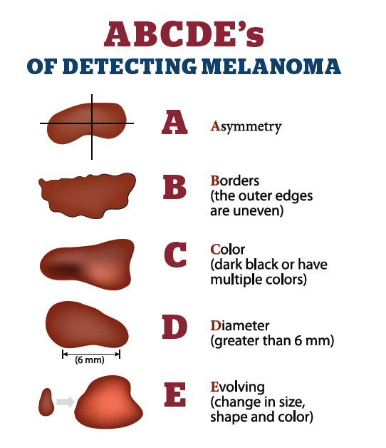 ABCDEs_Melanoma